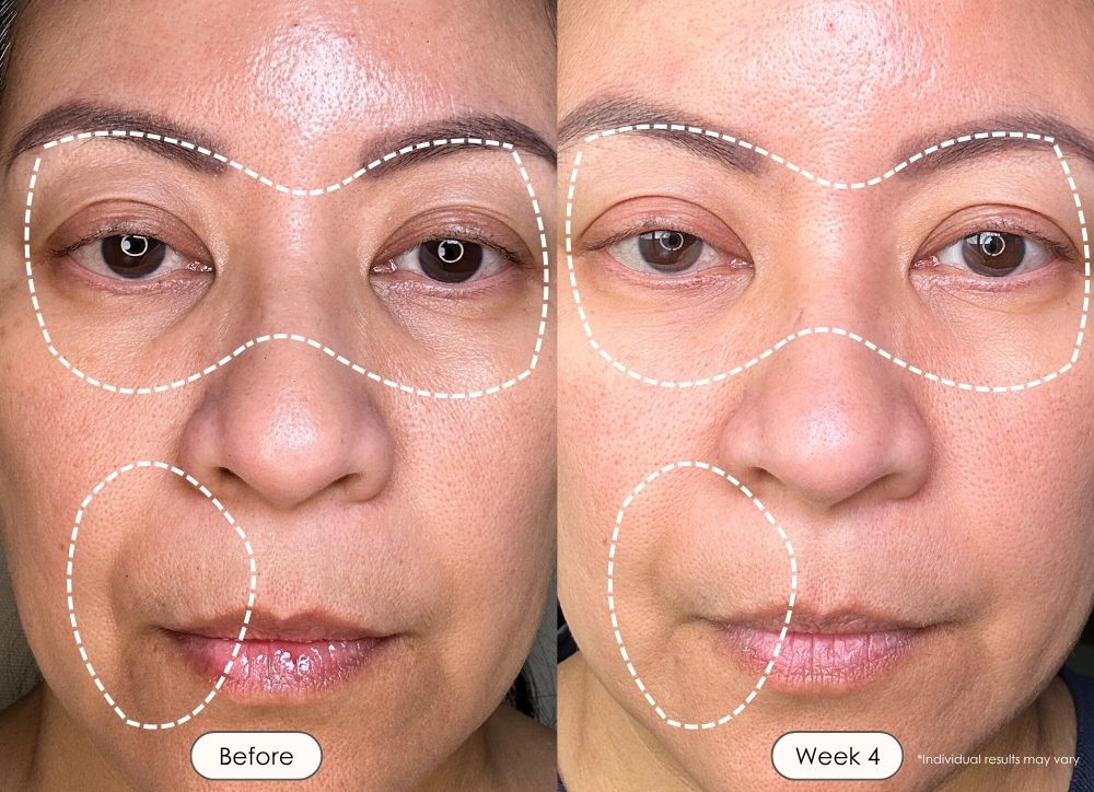 LumaLux Face Pro LED Light Therapy Mask: Our most advanced LED mask for deeper skin renewal - fine lines, acne, hyperpigmentation, skin texture