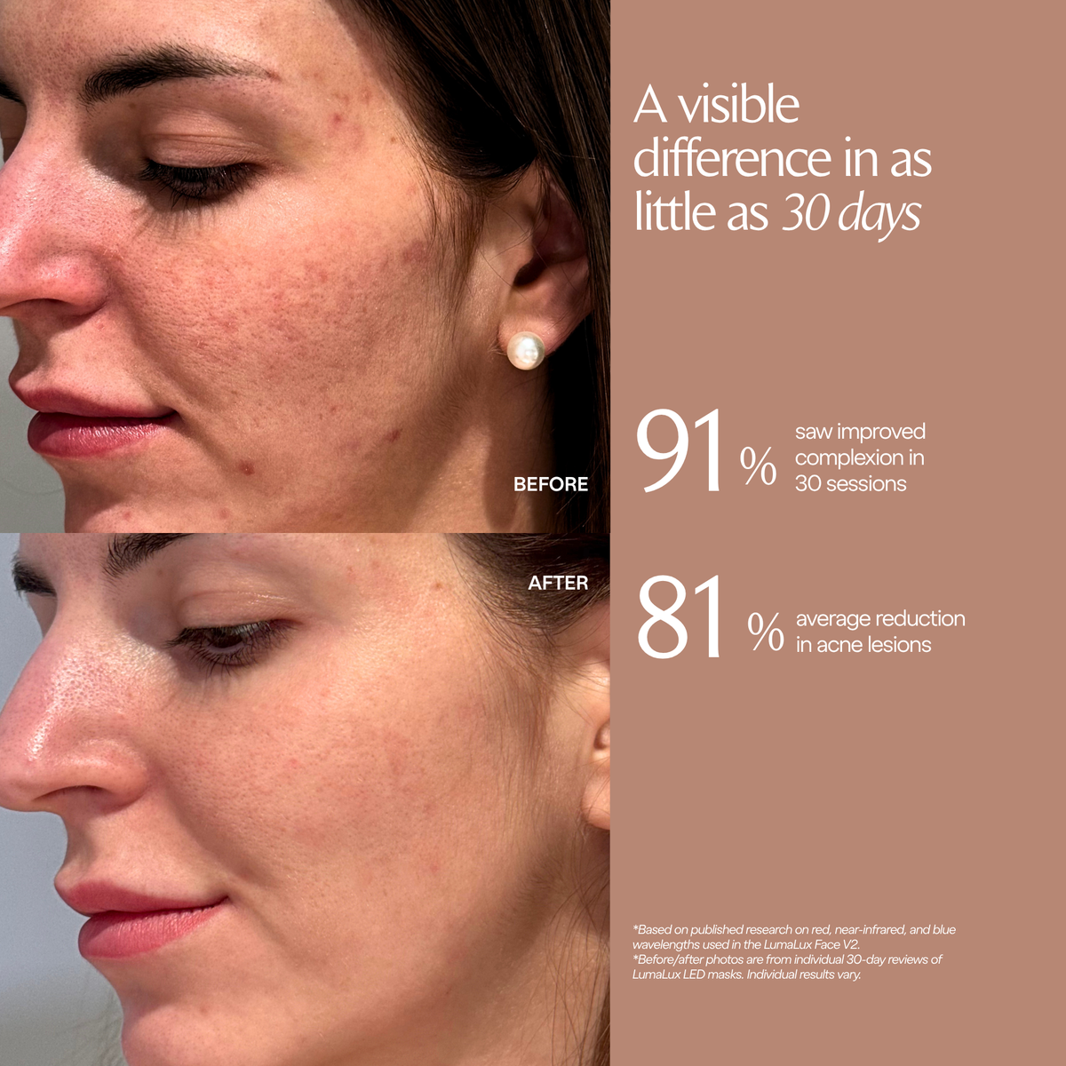 LumaLux Face V2 testimonial graphic with cheek photographs labelled before and after, plus study percentage callouts